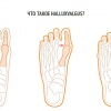 Вальгусная деформация первого пальца стопы (Hallux Valgus)